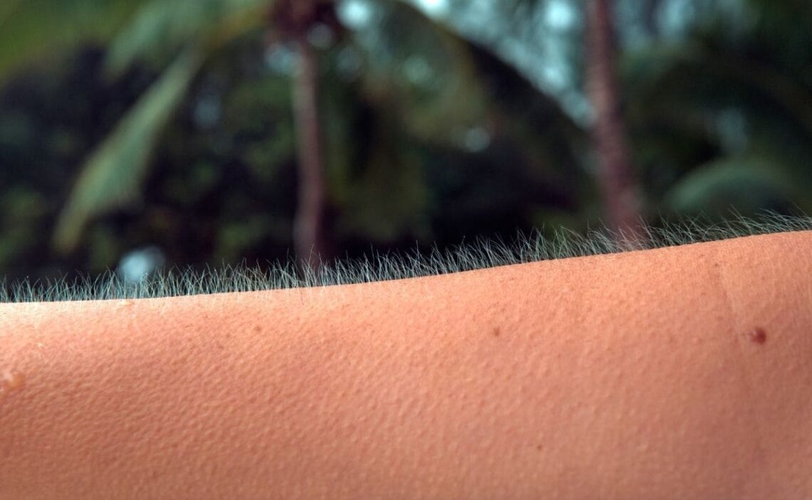 Así afecta la deficiencia de vitamina A al desarrollo de la queratosis pilaris