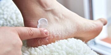 Recomendaciones de expertos para prevenir ampollas en la piel de los pies./ CANVA