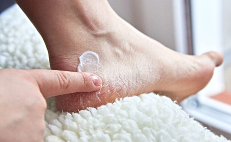 Recomendaciones de expertos para prevenir ampollas en la piel de los pies./ CANVA