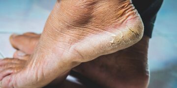 El remedio casero con bicarbonato para exfoliar los pies