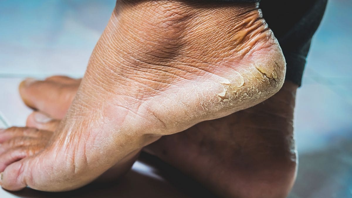 El remedio casero con bicarbonato para exfoliar los pies