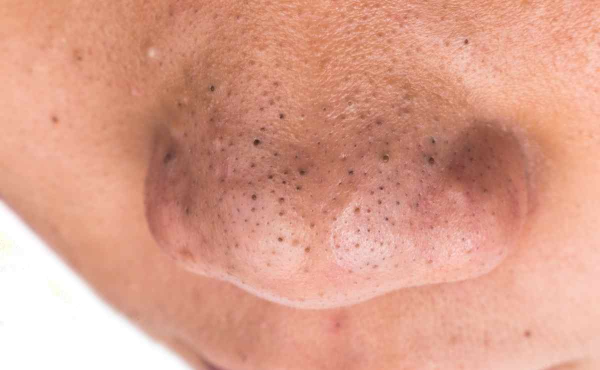 Remedios caseros para quitar los puntos negros de la nariz