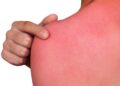 quemadura sol piel