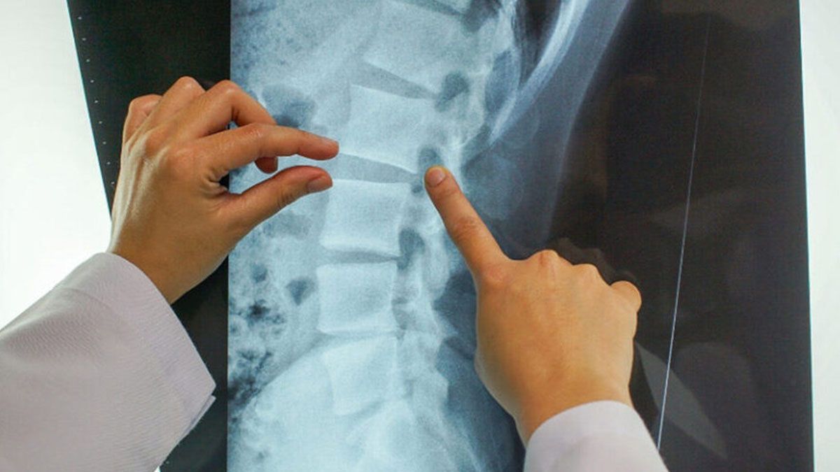 Radiografía columna mielitis transversa