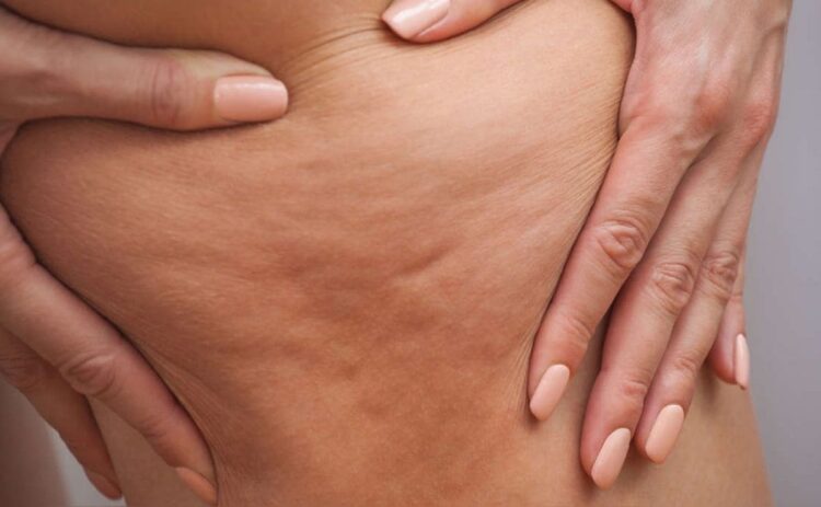 remedios caseros eliminar celulitis piel de naranja