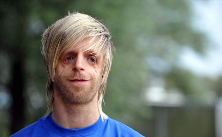 Sindrome de Treacher Collins - Enfermedad rara