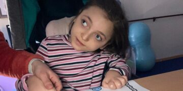 El síndrome por deficiencia CDKL5 es una enfermedad genética que se manifiesta a las pocas semanas de vida