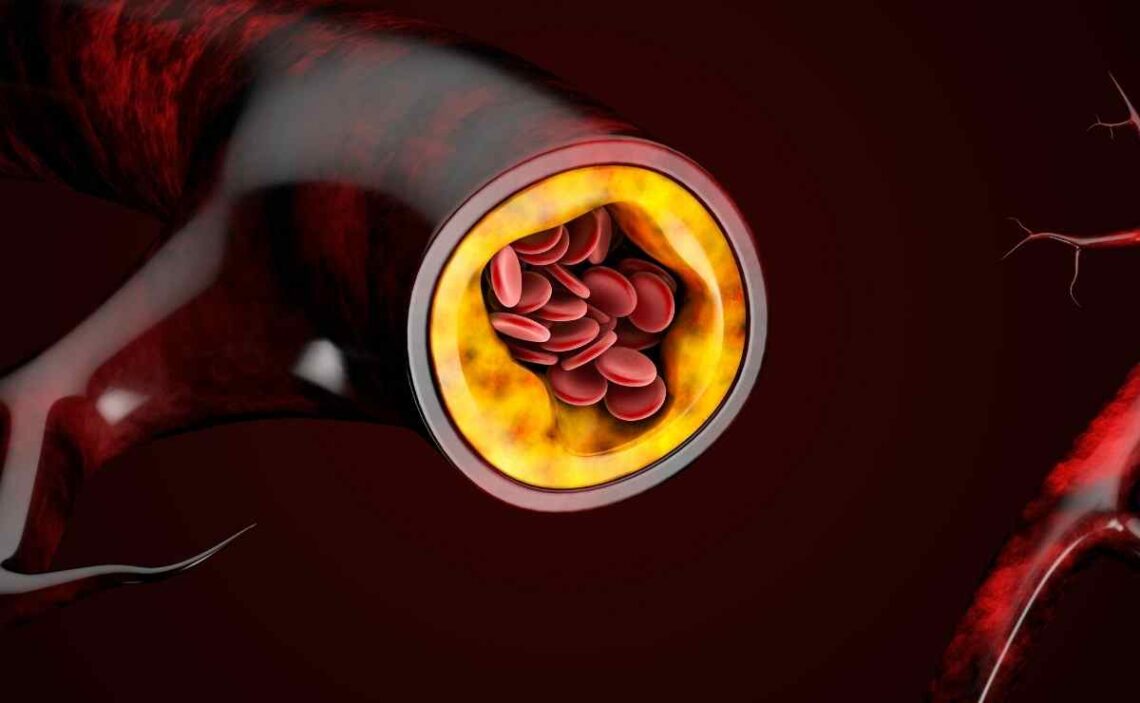 Estás son las razones de los triglicéridos altos: cómo actuar