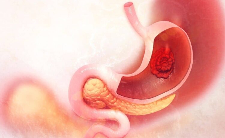 úlcera estómago digestivo microbiota intestino órgano alimento remedio natural