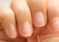 manchas, uñas