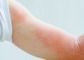 Ingredientes recomendados para aliviar el picor por urticaria en la piel