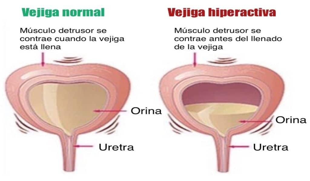 Definición de vejiga hiperactiva