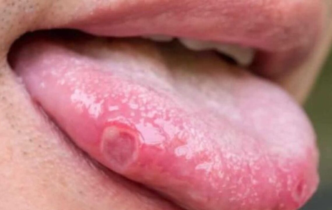 VPH - Verruga lengua
