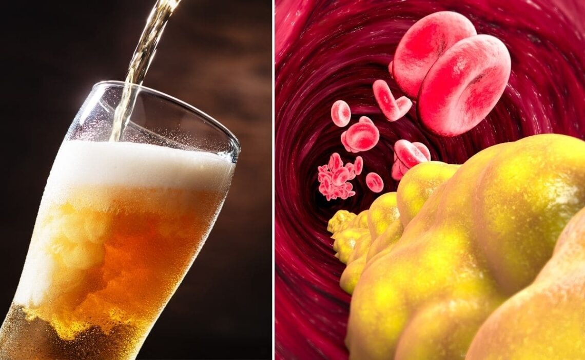 ¿Afecta tomar cerveza a los niveles de triglicéridos?