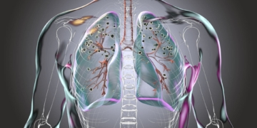 Incapacidad permanente por silicosis