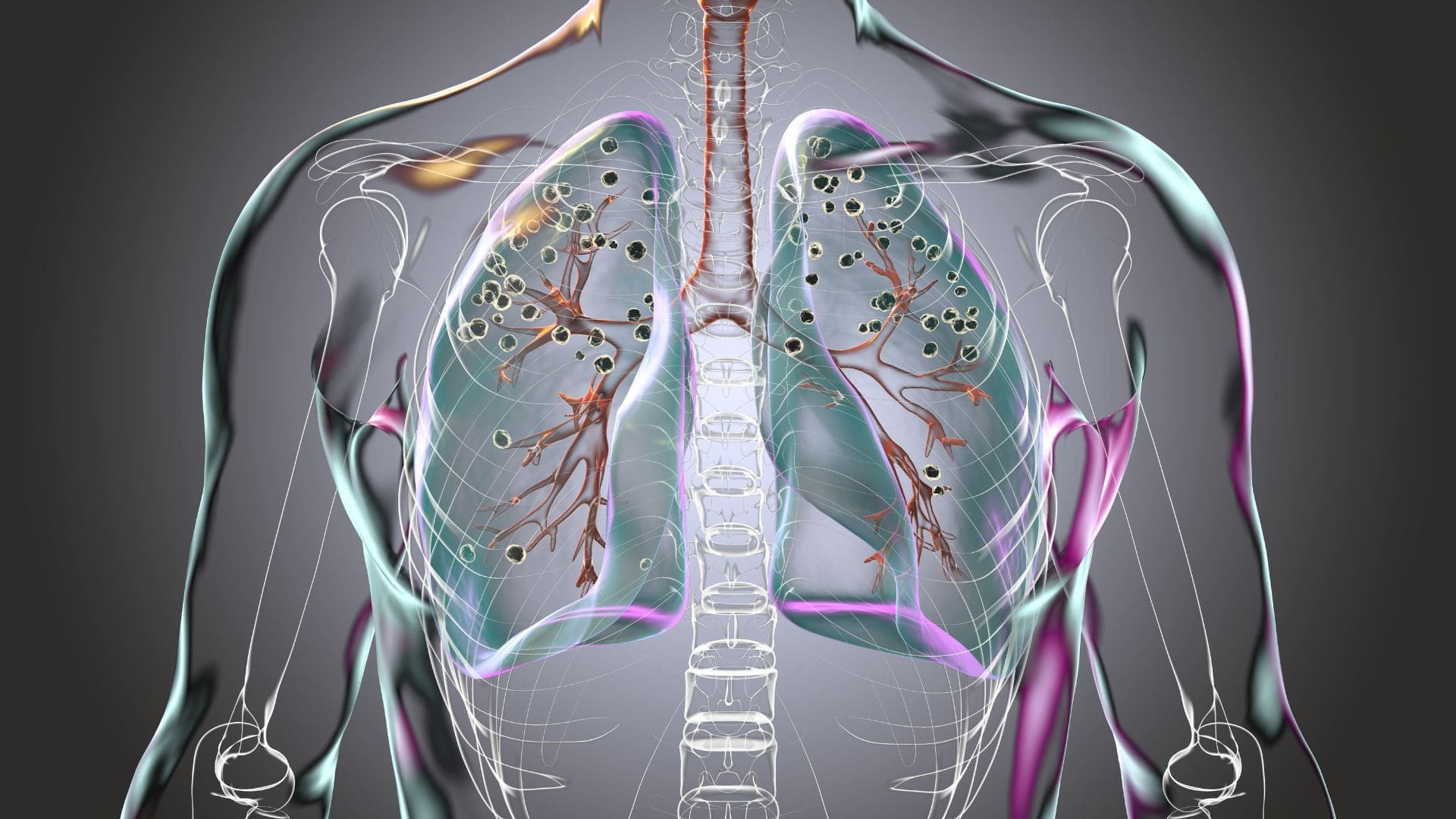 Incapacidad permanente por silicosis