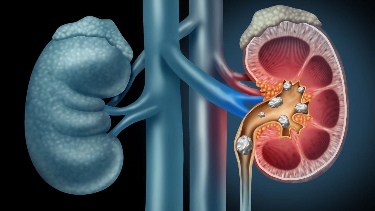 Síntomas de enfermedad riñones