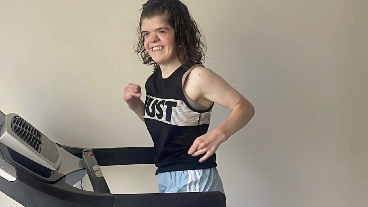 Carissa Resek, joven con síndrome de Apert